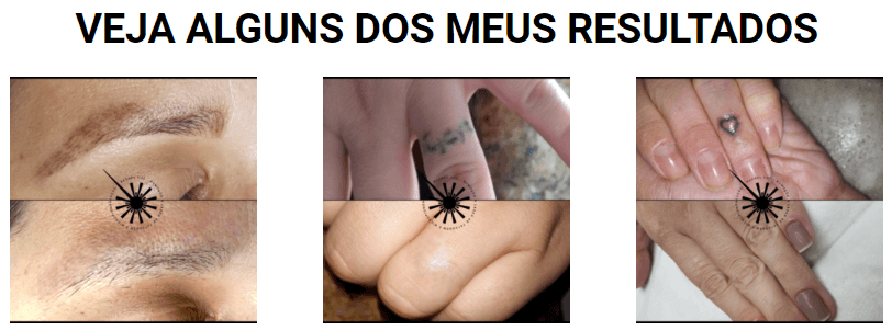 Remoção a Laser de Tatuagem Micropigmentação de Sobrancelhas
